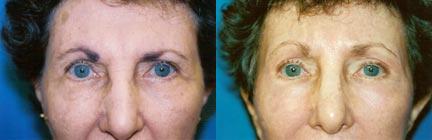 Eyelid Surgery Before & After Gallery - Patient 412955 - Image 2