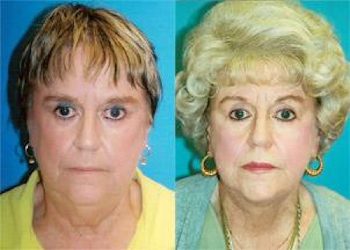 Facelift Before & After Gallery - Patient 122405821 - Image 1