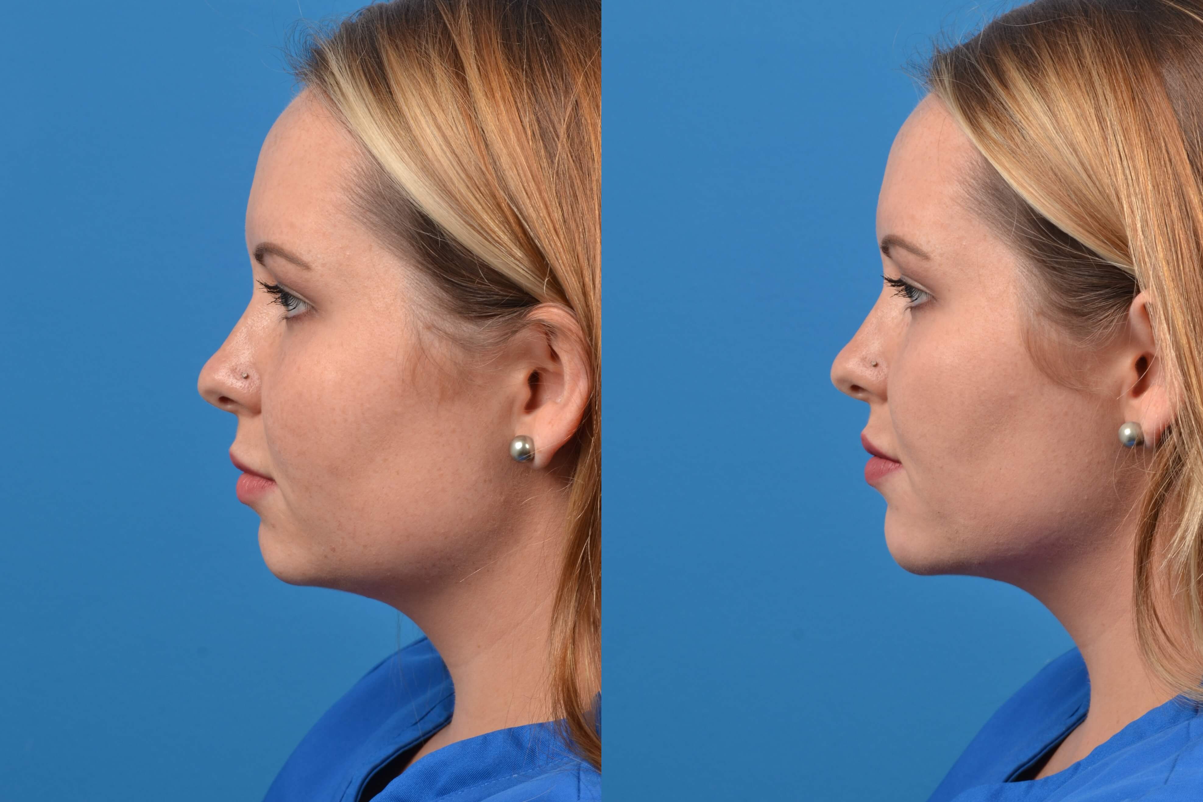 Dermal Fillers Before & After Gallery - Patient 122405825 - Image 2
