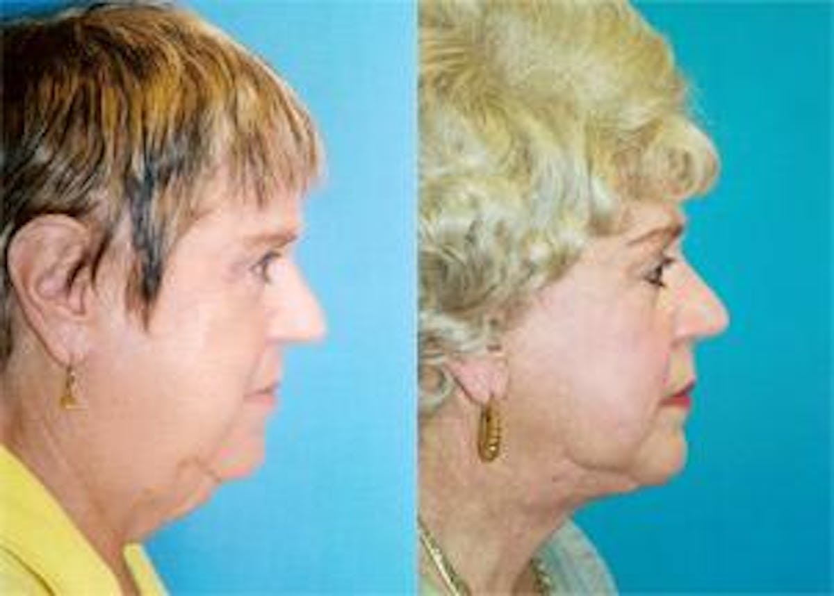 Facelift Before & After Gallery - Patient 122405821 - Image 2