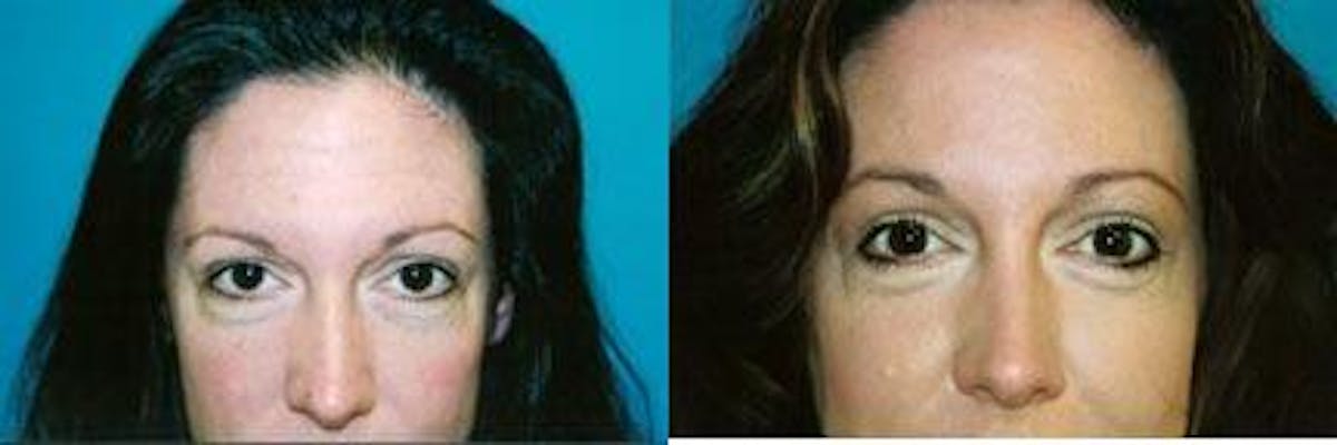Eyelid Surgery Before & After Gallery - Patient 122405822 - Image 1