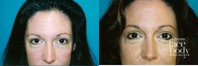 Eyelid Surgery Before & After Gallery - Patient 314195 - Image 1