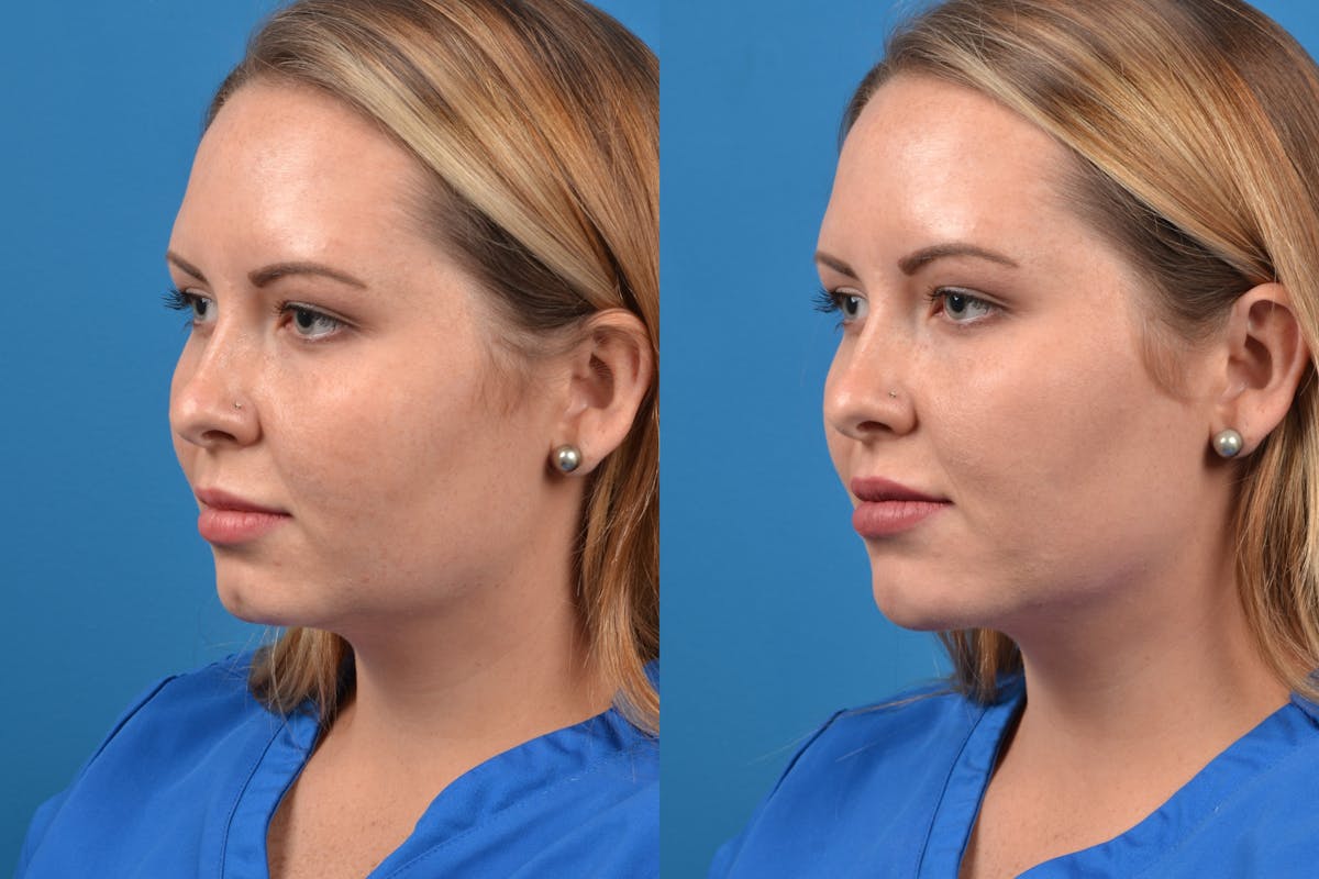Dermal Fillers Before & After Gallery - Patient 122405825 - Image 3