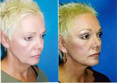Facelift Before & After Gallery - Patient 122405823 - Image 1