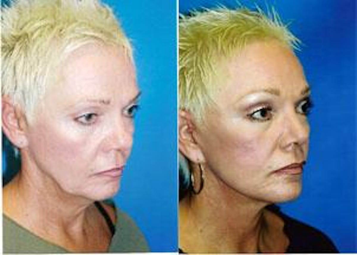 Facelift Before & After Gallery - Patient 122405823 - Image 1
