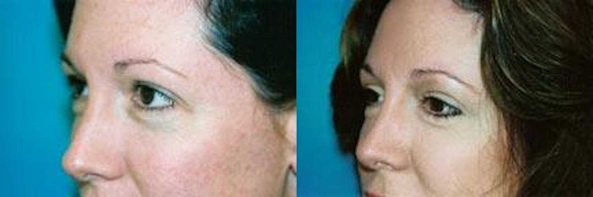 Eyelid Surgery Before & After Gallery - Patient 122405822 - Image 2