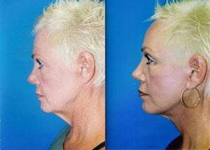 Facelift Before & After Gallery - Patient 122405823 - Image 2