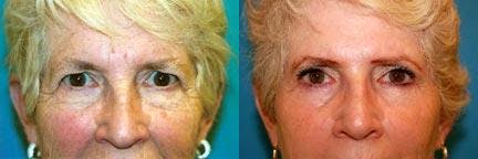 Eyelid Surgery Before & After Gallery - Patient 122405824 - Image 1