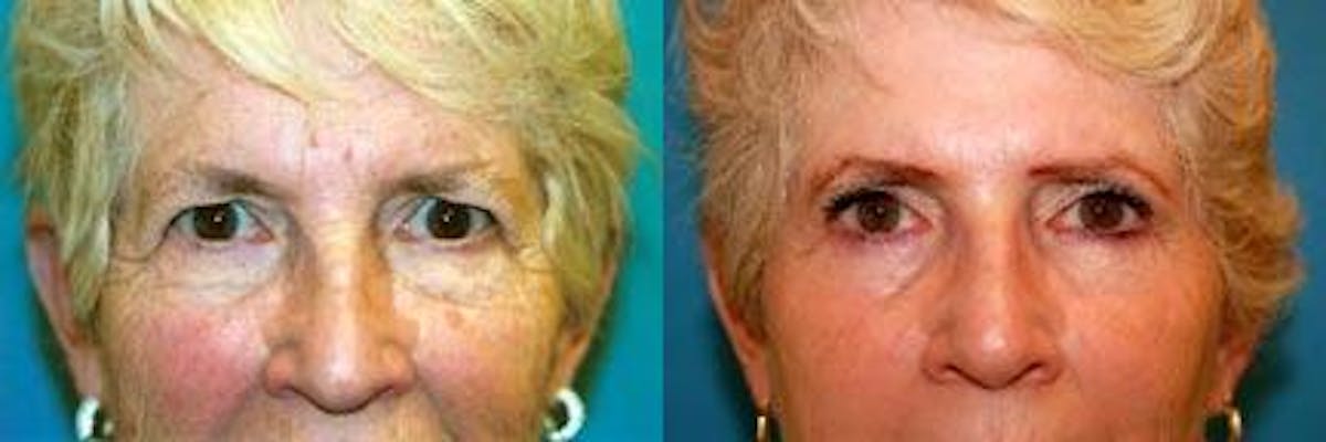 Eyelid Surgery Before & After Gallery - Patient 122405824 - Image 1