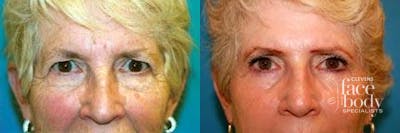 Eyelid Surgery Before & After Gallery - Patient 351907 - Image 1