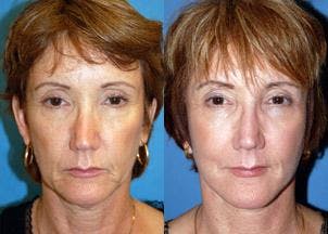 Facelift Before & After Gallery - Patient 122405826 - Image 1
