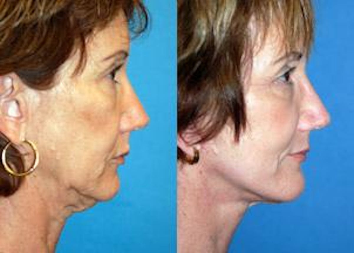 Facelift Before & After Gallery - Patient 122405826 - Image 2