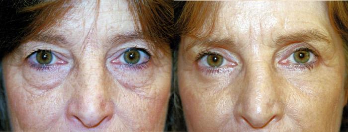 Eyelid Surgery Before & After Gallery - Patient 417173 - Image 1