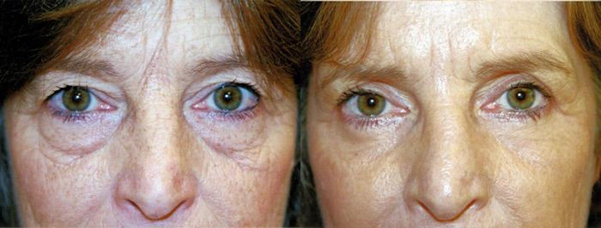 Eyelid Surgery Before & After Gallery - Patient 122405828 - Image 1