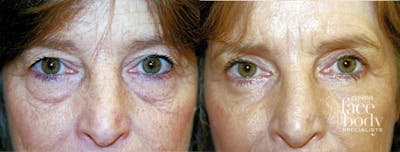 Eyelid Surgery Before & After Gallery - Patient 417173 - Image 1