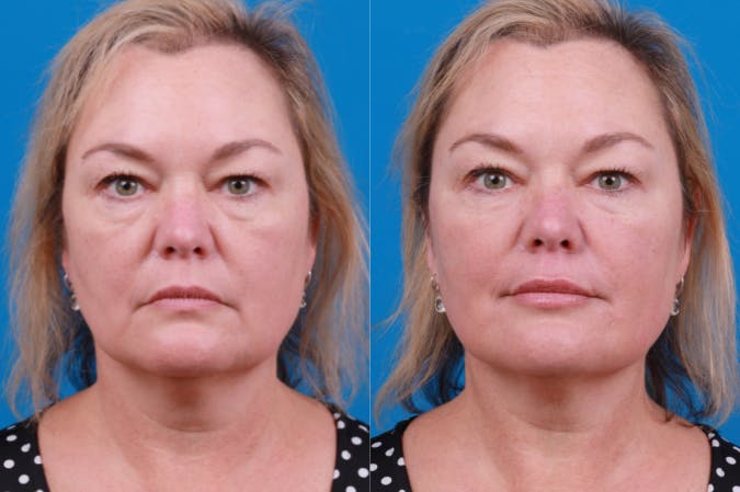 Dermal Fillers Before & After Gallery - Patient 122405835 - Image 1