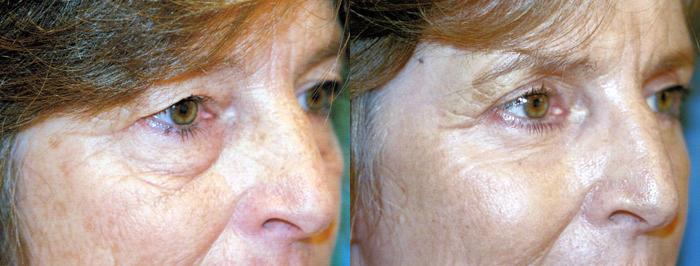 Eyelid Surgery Before & After Gallery - Patient 417173 - Image 2