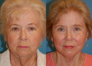 Facelift Before & After Gallery - Patient 122405830 - Image 1