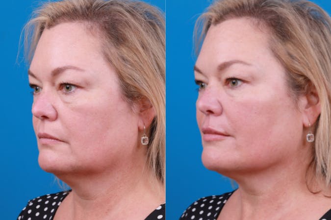 Dermal Fillers Before & After Gallery - Patient 122405835 - Image 2