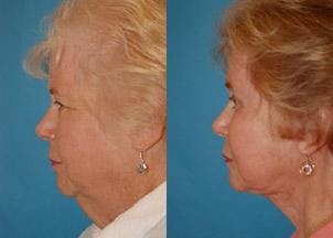 Facelift Before & After Gallery - Patient 122405830 - Image 2