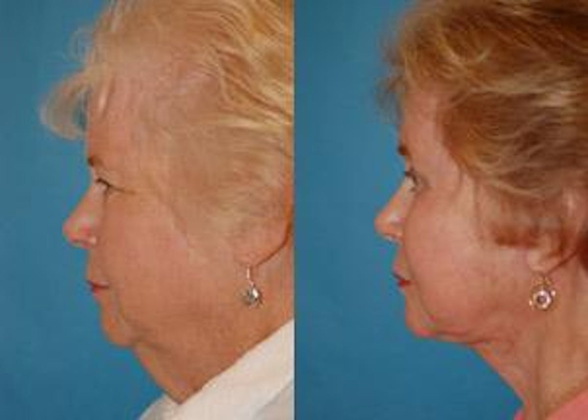 Facelift Before & After Gallery - Patient 122405830 - Image 2