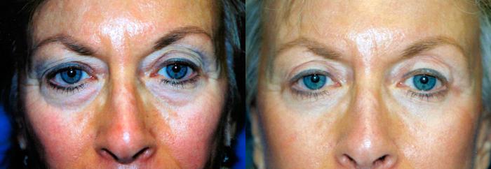 Eyelid Surgery Before & After Gallery - Patient 301747 - Image 1
