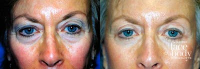 Eyelid Surgery Before & After Gallery - Patient 301747 - Image 1