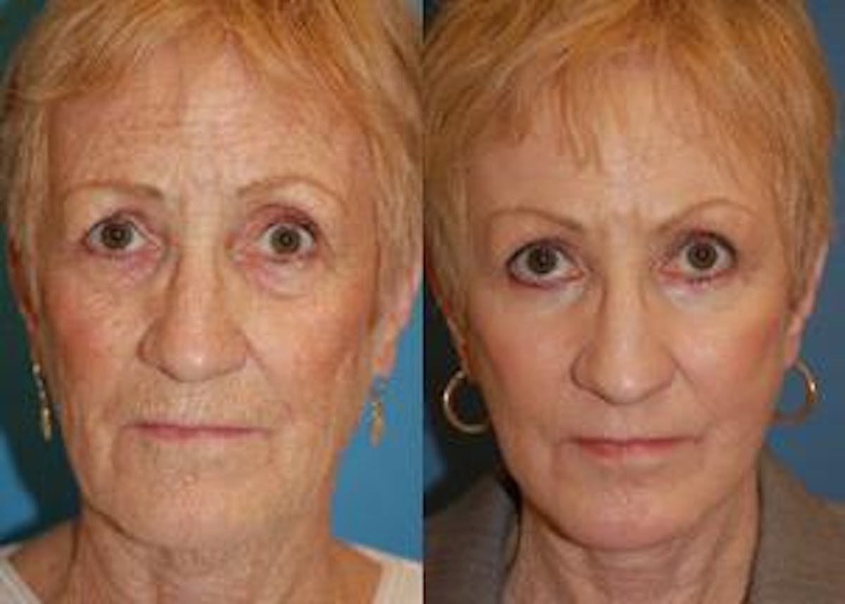 Facelift Before & After Gallery - Patient 122405832 - Image 1