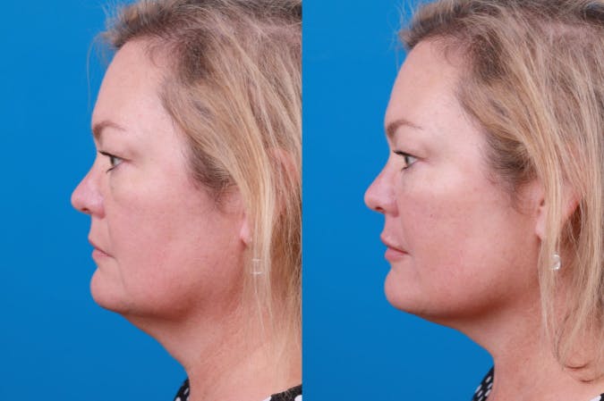 Dermal Fillers Before & After Gallery - Patient 122405835 - Image 3