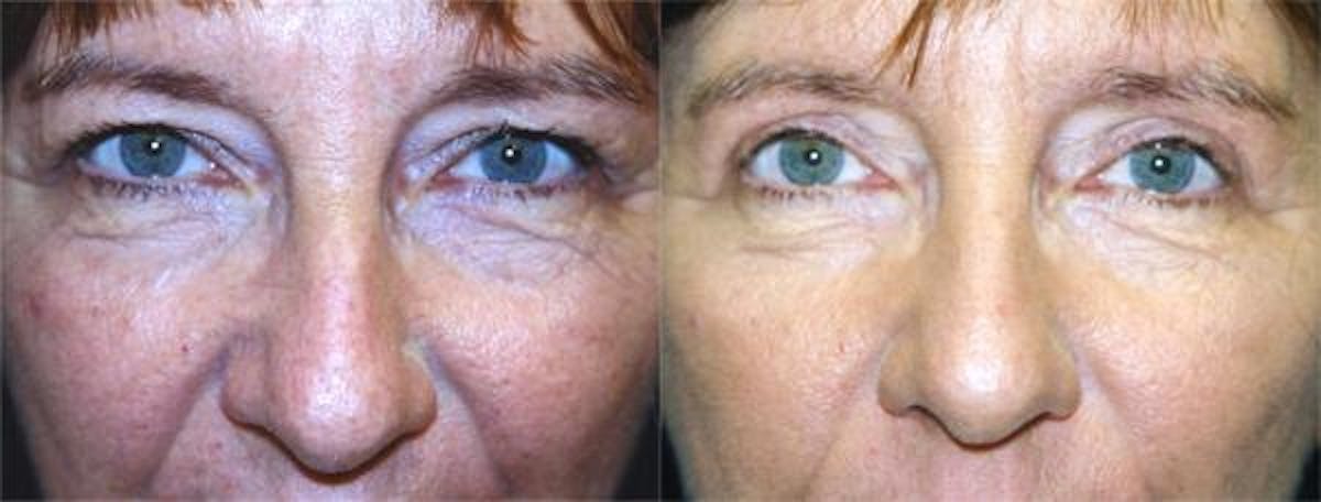 Eyelid Surgery Before & After Gallery - Patient 122405833 - Image 1