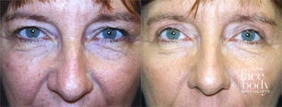 Eyelid Surgery Before & After Gallery - Patient 690007 - Image 1
