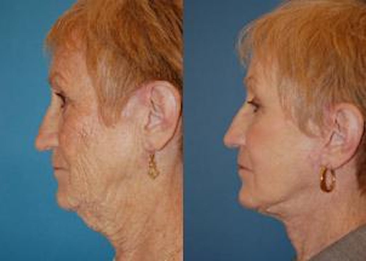 Facelift Before & After Gallery - Patient 122405832 - Image 2