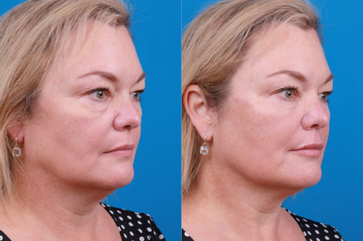 Dermal Fillers Before & After Gallery - Patient 122405835 - Image 4