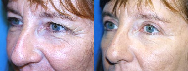 Eyelid Surgery Before & After Gallery - Patient 690007 - Image 2