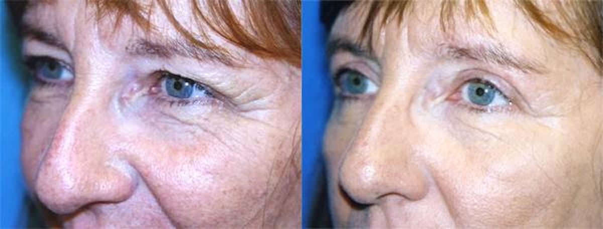 Eyelid Surgery Before & After Gallery - Patient 122405833 - Image 2