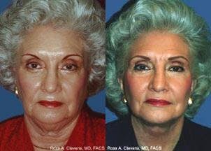 Facelift Before & After Gallery - Patient 122405834 - Image 1