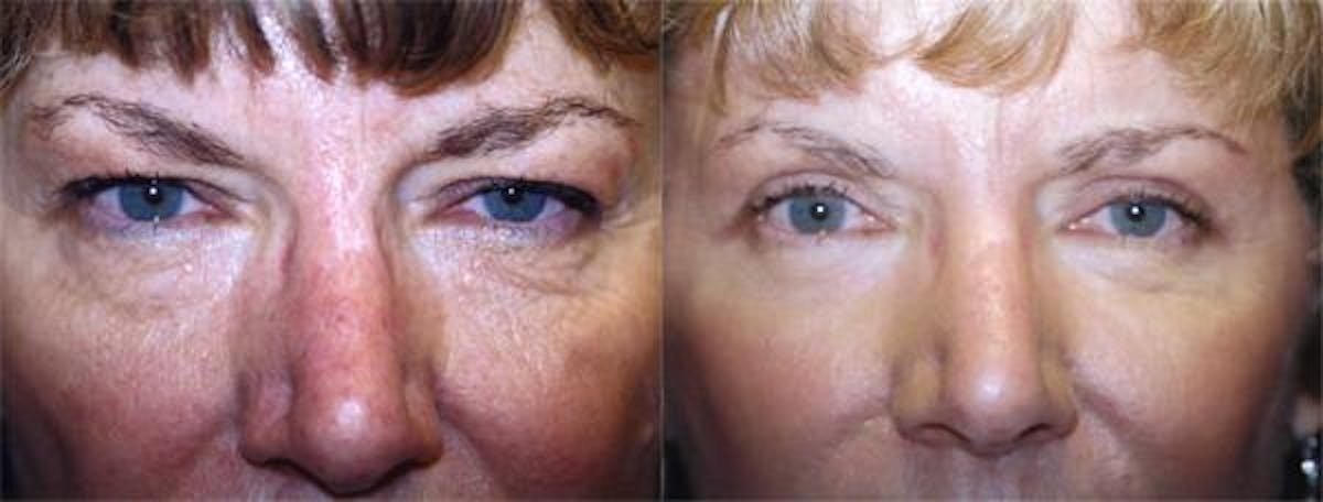 Eyelid Surgery Before & After Gallery - Patient 122405836 - Image 1