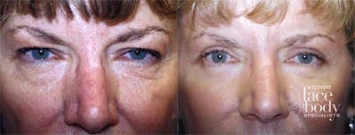 Eyelid Surgery Before & After Gallery - Patient 171409 - Image 1