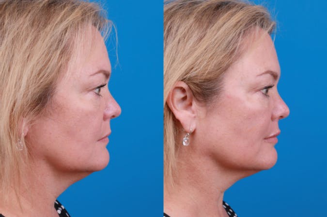 Dermal Fillers Before & After Gallery - Patient 122405835 - Image 5