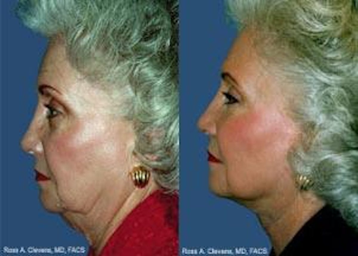 Facelift Before & After Gallery - Patient 122405834 - Image 2