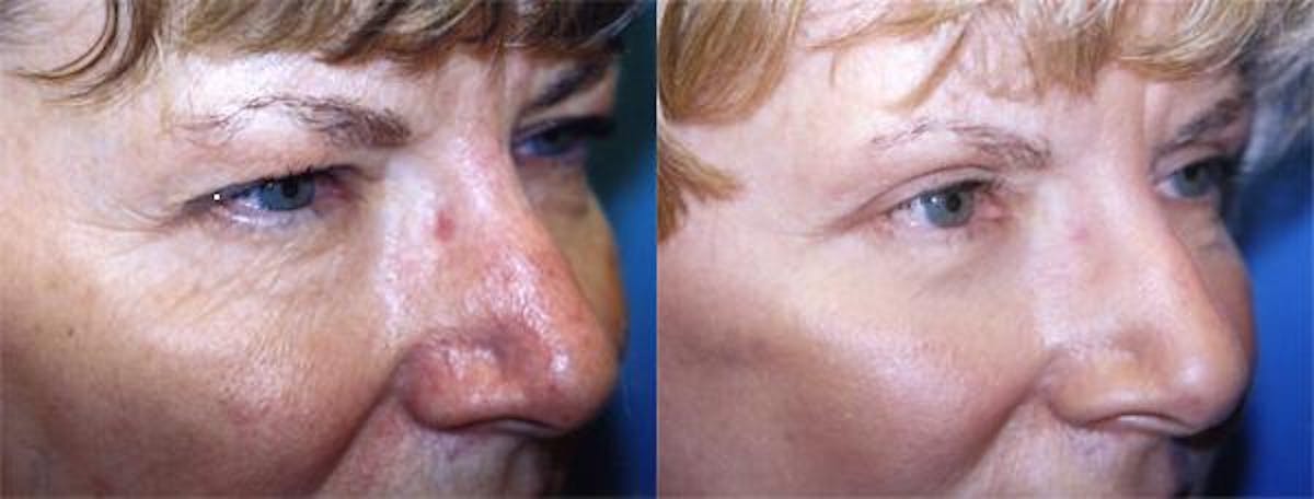 Eyelid Surgery Before & After Gallery - Patient 122405836 - Image 2
