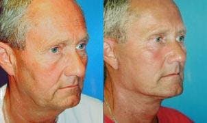 Facelift Before & After Gallery - Patient 122405838 - Image 1