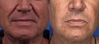 Dermal Fillers Before & After Gallery - Patient 122405839 - Image 1
