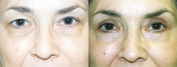 Eyelid Surgery Before & After Gallery - Patient 122405837 - Image 1