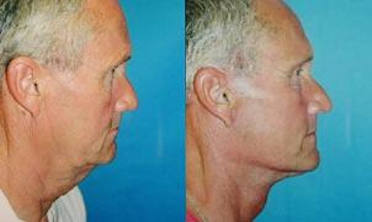 Facelift Before & After Gallery - Patient 122405838 - Image 2