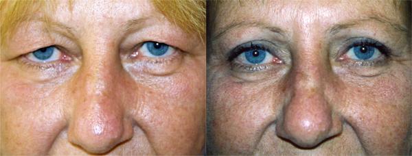 Eyelid Surgery Before & After Gallery - Patient 350270 - Image 1