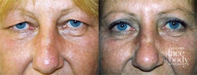 Eyelid Surgery Before & After Gallery - Patient 350270 - Image 1