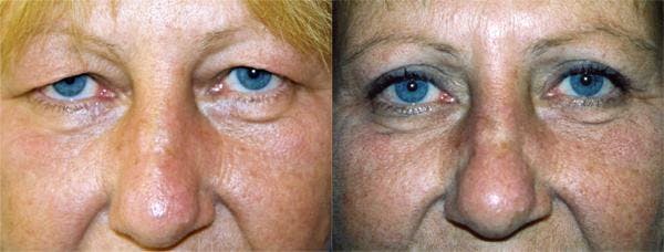 Eyelid Surgery Before & After Gallery - Patient 122405841 - Image 1