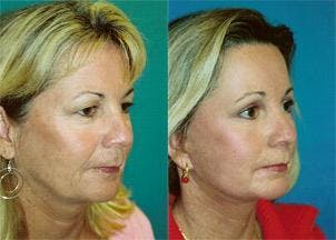 Facelift Before & After Gallery - Patient 122405840 - Image 1