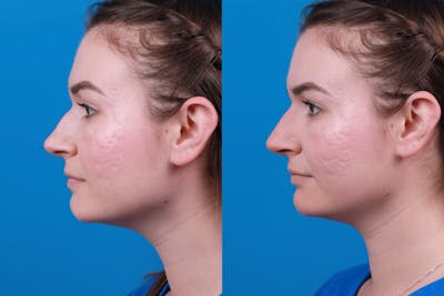 Dermal Fillers Before & After Gallery - Patient 122405853 - Image 1